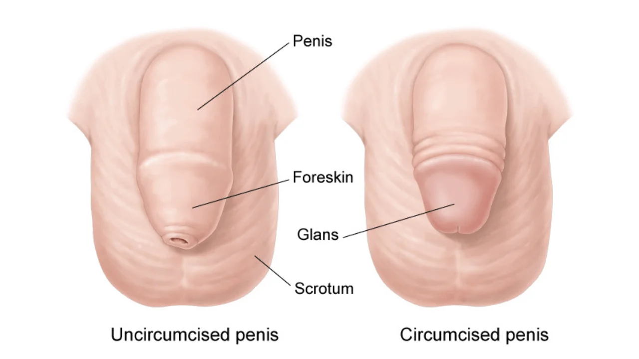 Circumcision