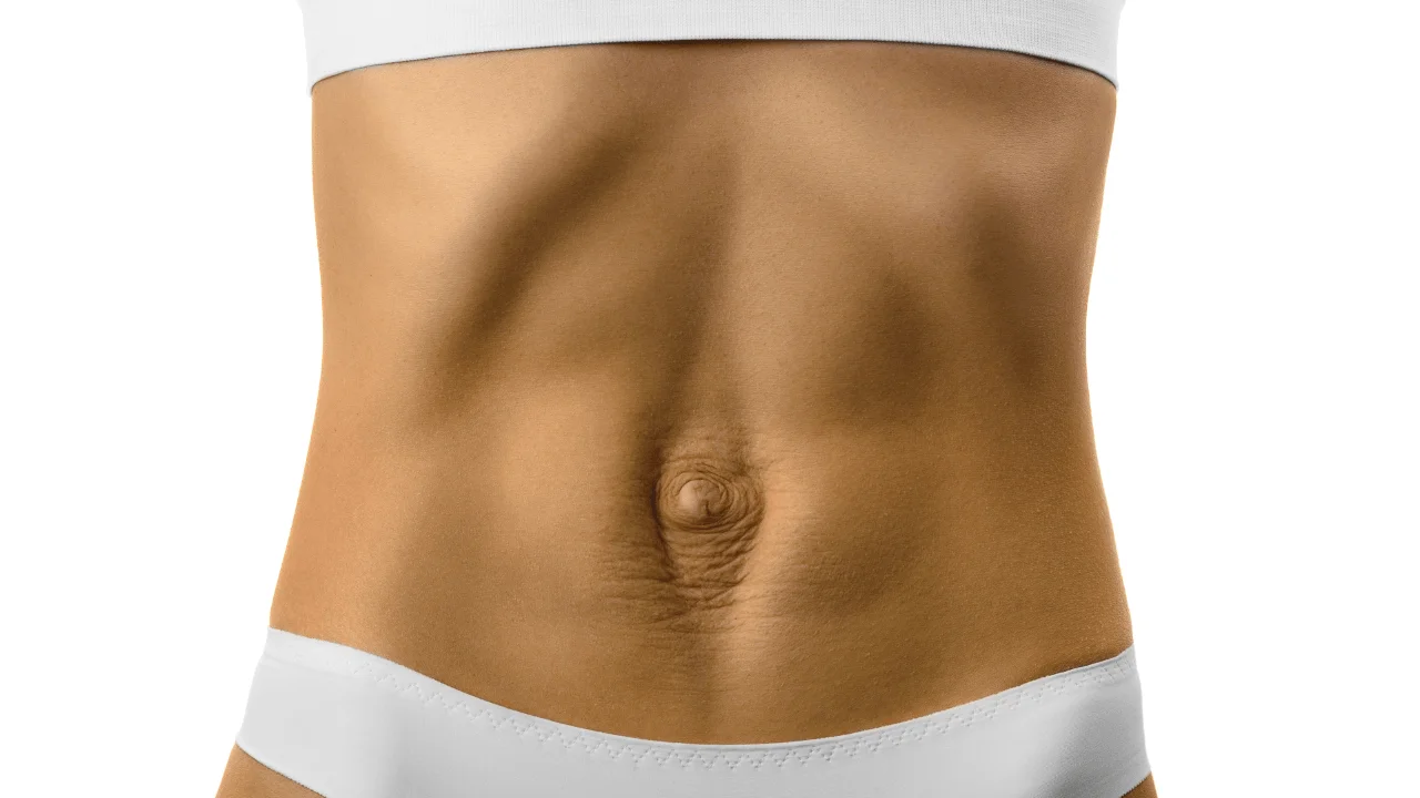 Diastasis recti