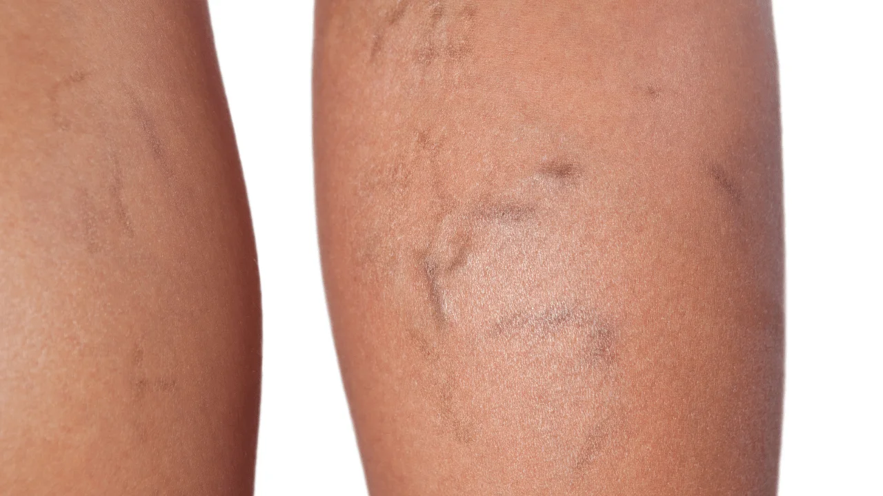 Postpartum varicose veins